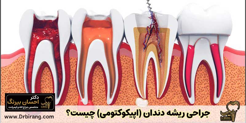جراحی ریشه دندان (اپیکواکتومی) چیست؟
