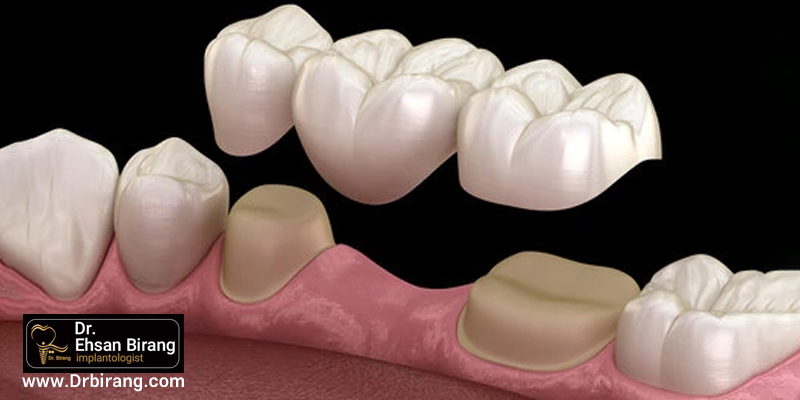 Dental Bridge