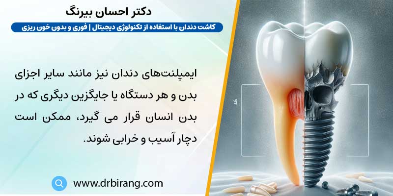 ایمپلنت دندان خراب می شود؟