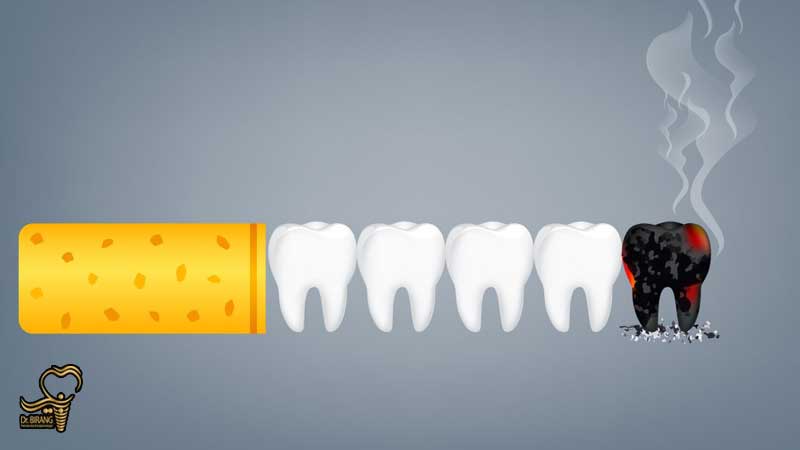 چگونگی تأثیر دخانیات بر موفقیت ایمپلنت دندان