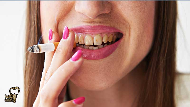 مراقبت های لازم افراد سیگاری با ایمپلنت دندان