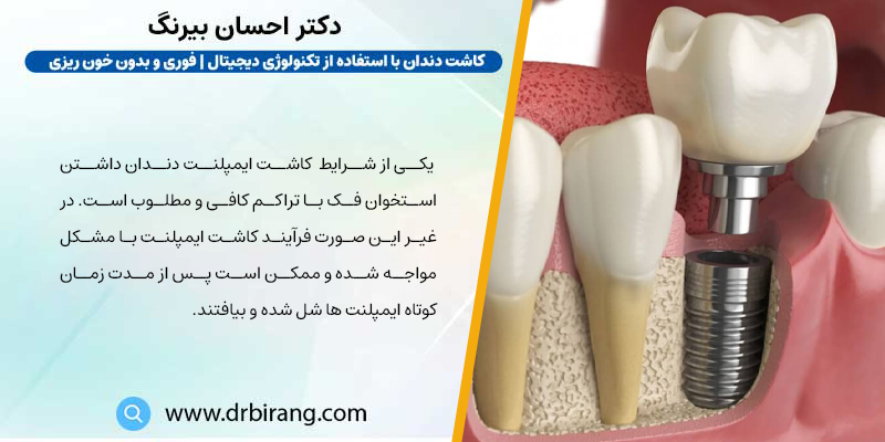 پوکی استخوان می تواند باهث شل شدن ایمپلنت دندان شود