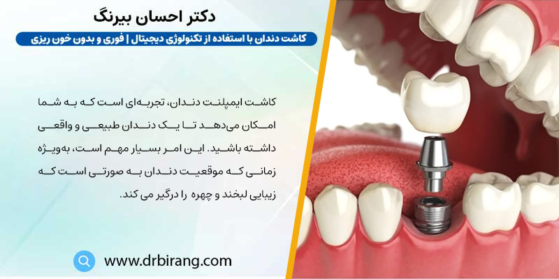 ایمپلنت دندان از لحاظ ظاهری بسیار شبیه به دندان طبیعی است