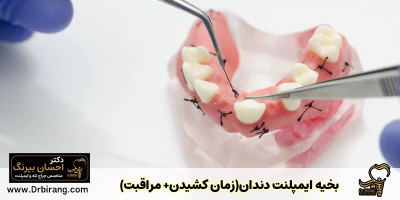 بخیه ایمپلنت دندان(زمان کشیدن+ مراقبت)