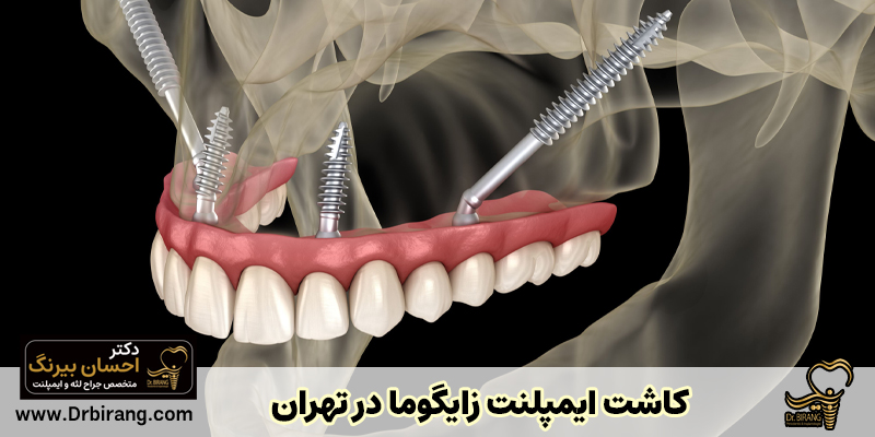 همه چیز درباره ایمپلنت زیگوماتیک: مزایا و معایب+هزینه‌ها