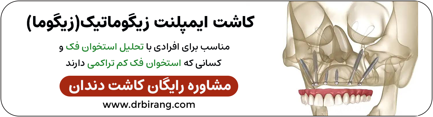کاشت ایمپلنت زایگوما