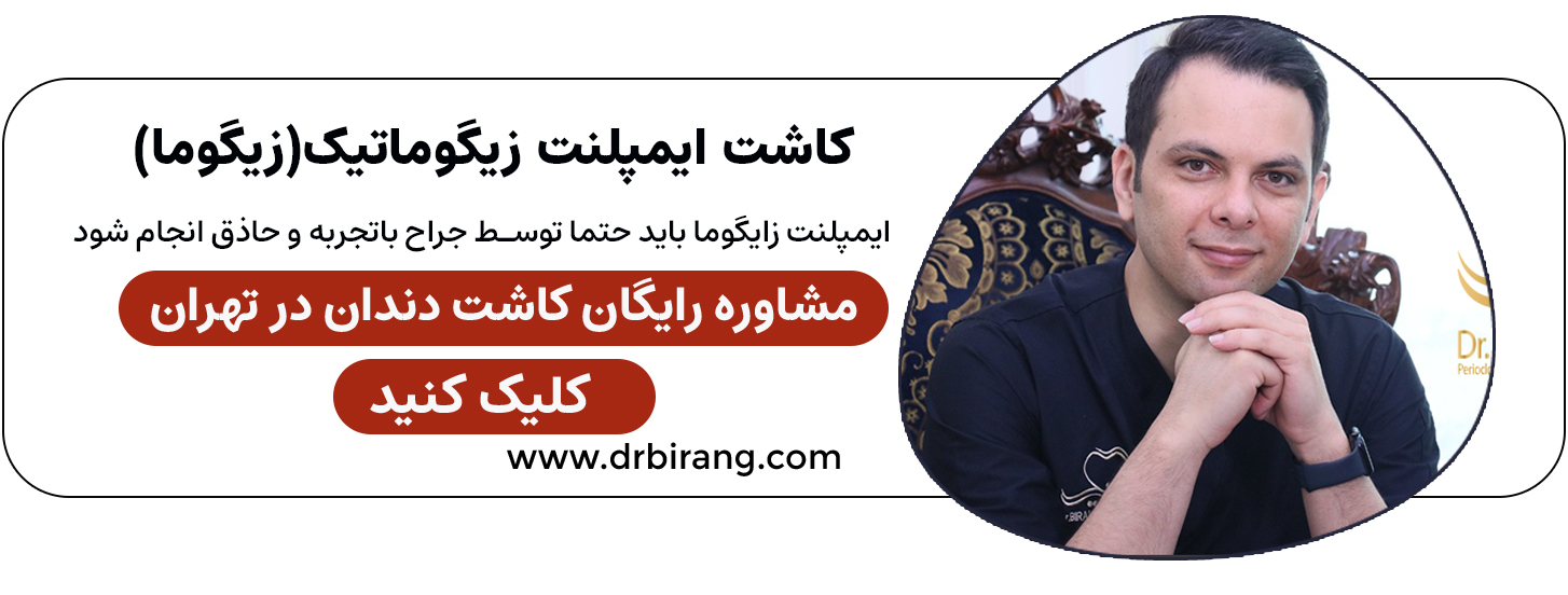 کاشت ایمپلنت زایگوماتیک در تهران | دکتر احسان بیرنگ