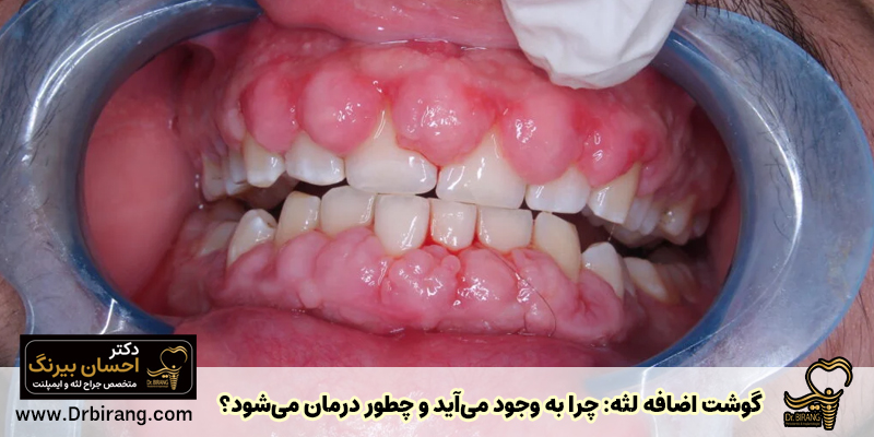 Excess gum tissue: why it occurs and How is it treated?