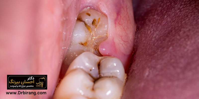 What is excess gum tissue and why does it occur?