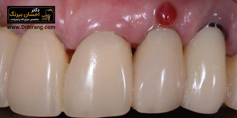 Excess gum tissue after implant