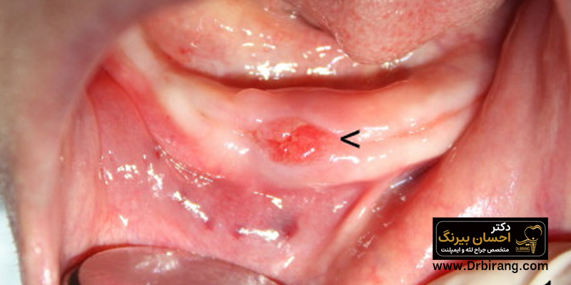 Excess gum tissue after surgery and tooth extraction
