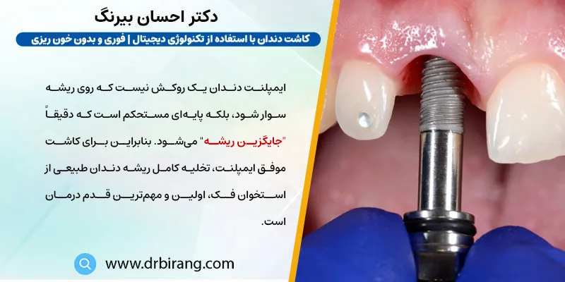 آیا برای ایمپلنت نیاز به ریشه دندان است؟