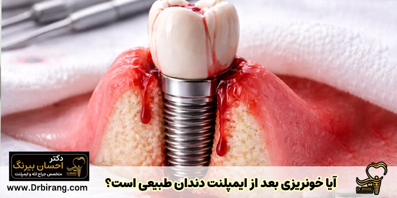 خونریزی بعد از ایمپلنت دندان