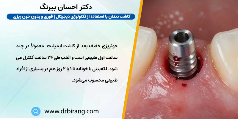 آیا خونریزی بعد از کاشت ایمپلنت طبیعی است؟