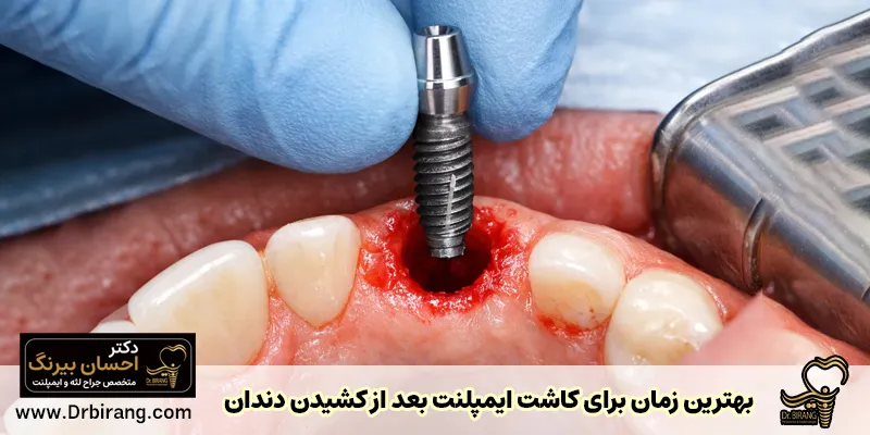 بهترین زمان برای کاشت ایمپلنت بعد از کشیدن دندان