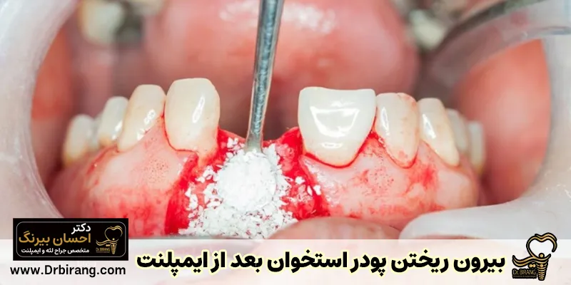 بیرون ریختن پودر استخوان بعد از ایمپلنت؛ دلایل، راهکارها و زمان نگرانی