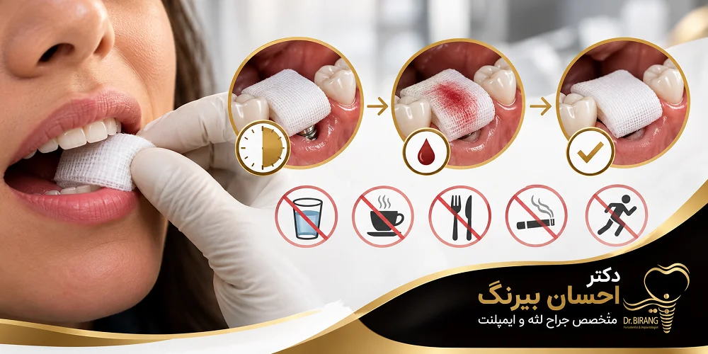 گاز استریل بعد از ایمپلنت؛ چند دقیقه بگذاریم و کی برداریم؟
